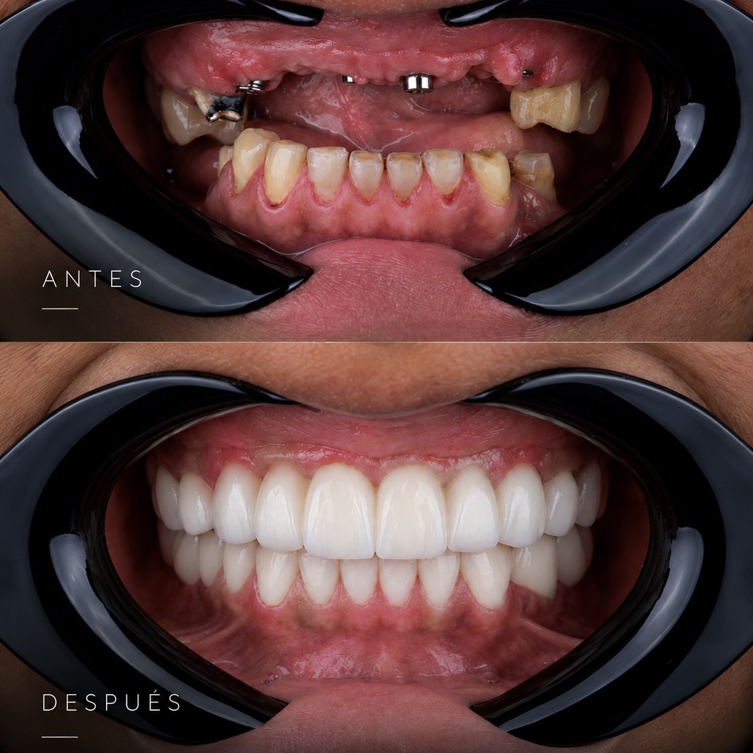 Caso 1 antes y después: vista intraoral antes del tratamiento y después de coronas sobre implantes
